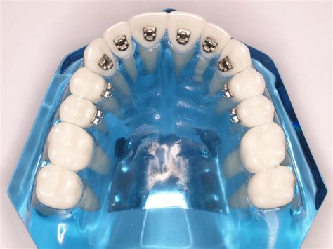orthocant|Top rated certified lingual labs for adenta .